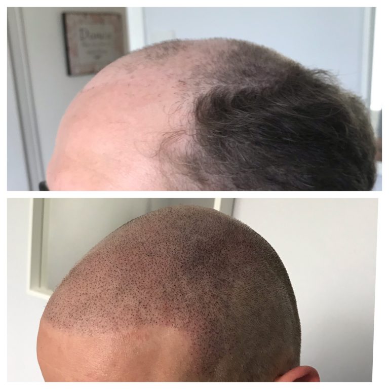 scalp tattoo transformation