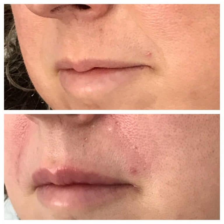 NoNeedle Lip Filler