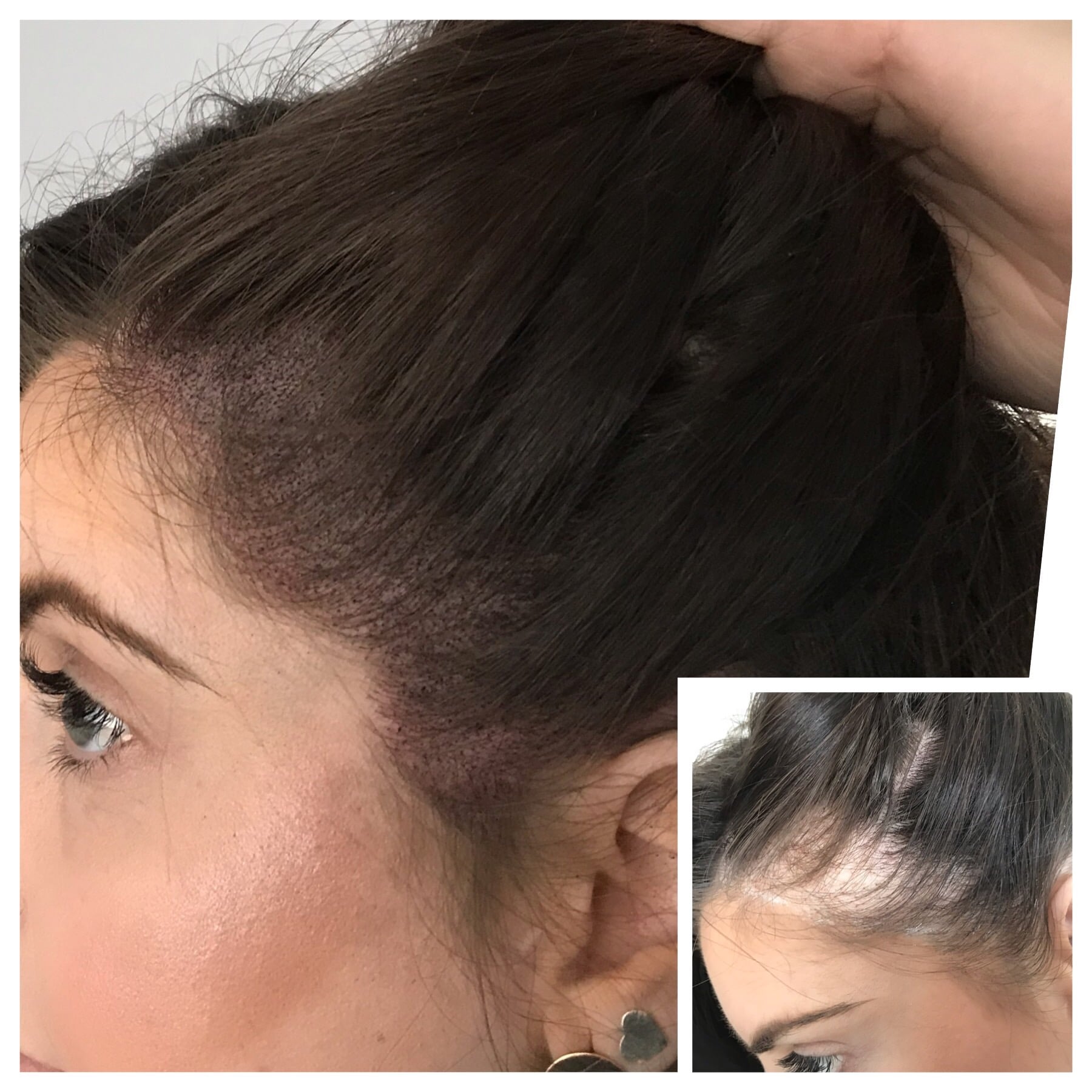 scalp micropigmentation halifax