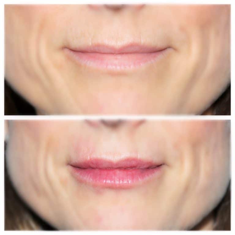 no needle lip filler