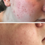 acne scarring treatments