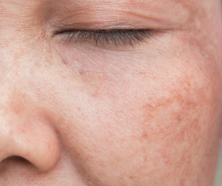 hyperpigmentation treatments