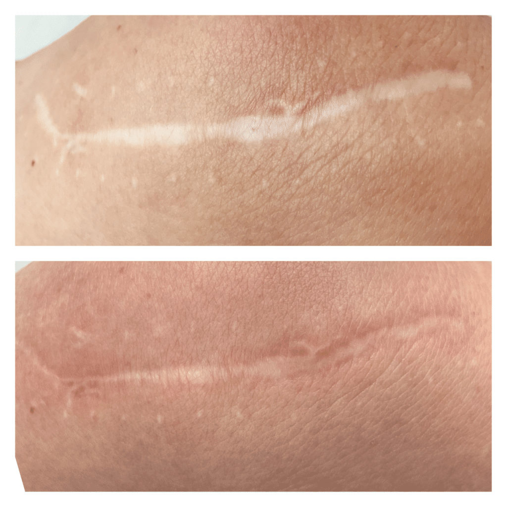 How to get rid of scars on legs Nikki Butler Skin Specialist in