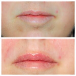 naturally fuller lips before and after