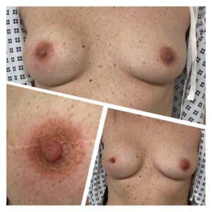 before and after of nipple tattoo