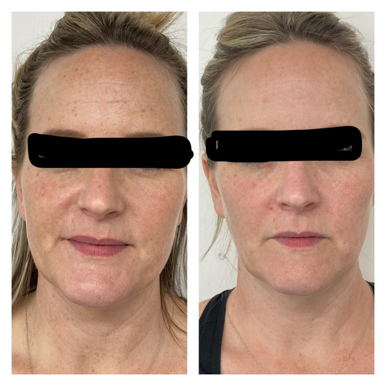 before and after of 2 IPL photofacials and 1 RF microneedling treatment