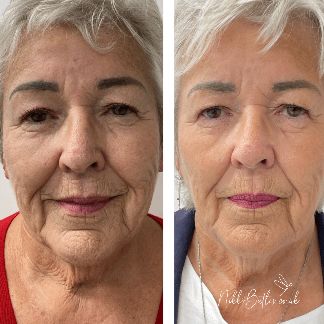 lady before and after HIFU facial