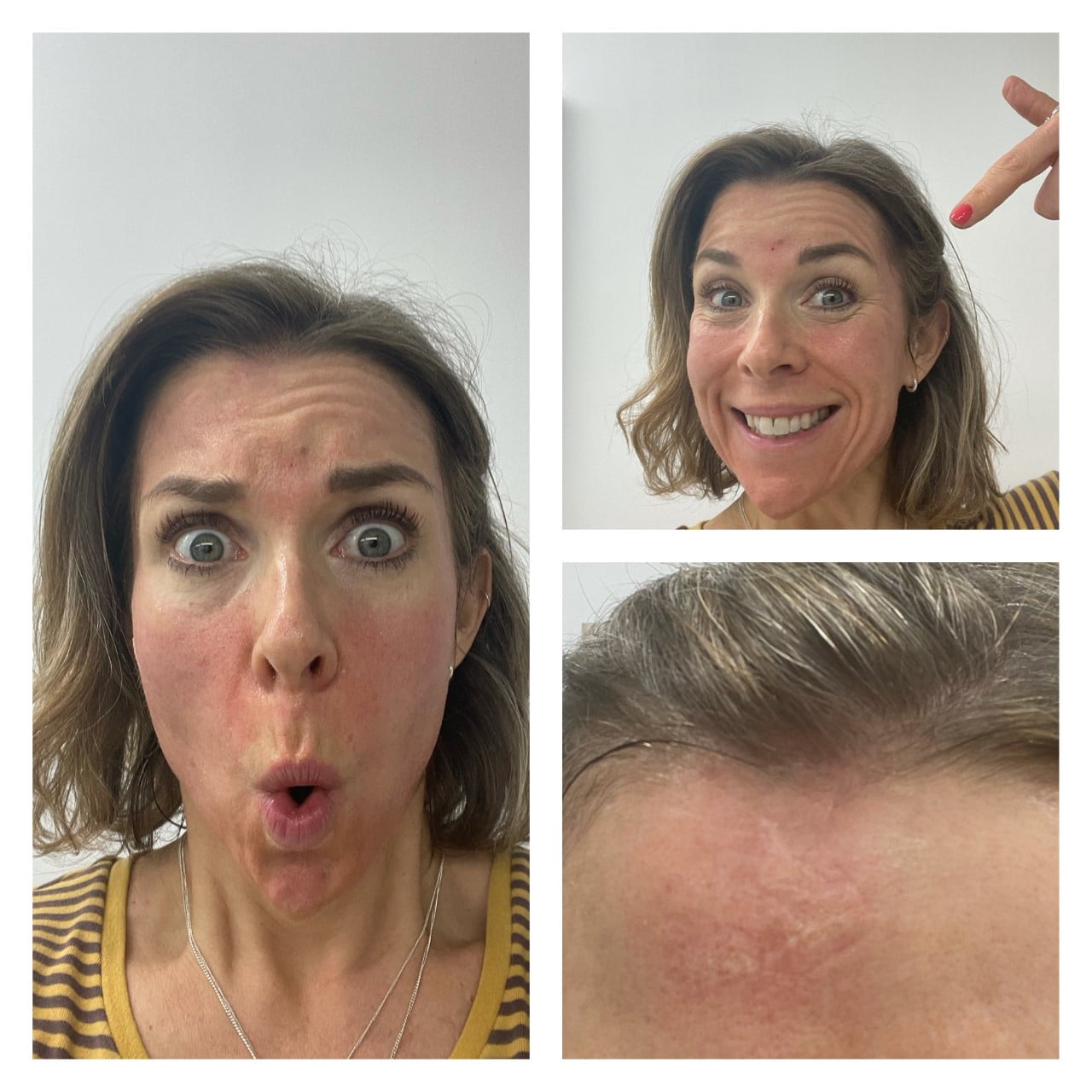 Microneedling Before and After Results Nikki Butler Skin Specialist in Hampshire.