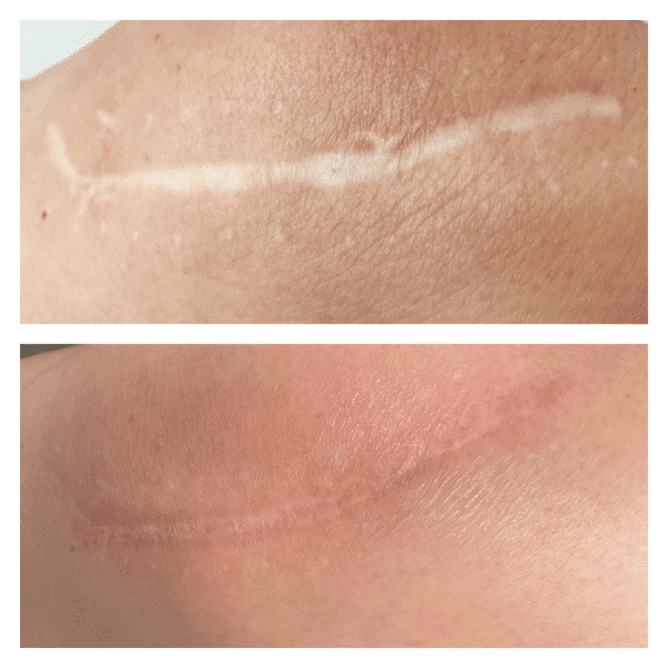 scar treatment before and after