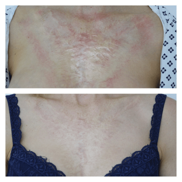 before and after radiofrequency microneedling on burn scars