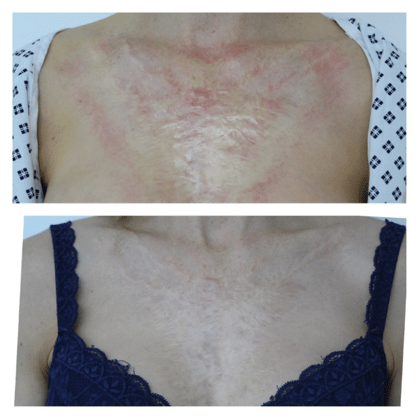 before and after radiofrequency microneedling scar treatment