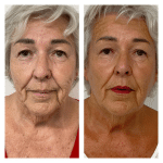 before and after radiofrequency microneedling treatment on lady