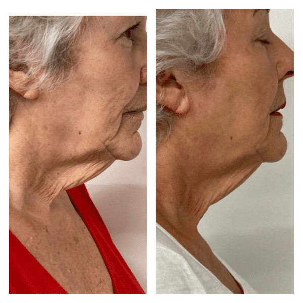 skin tightening before and after on ladies neck