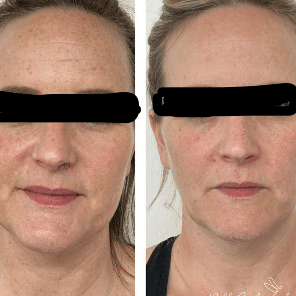 before and after IPL skin rejuvenation treatment