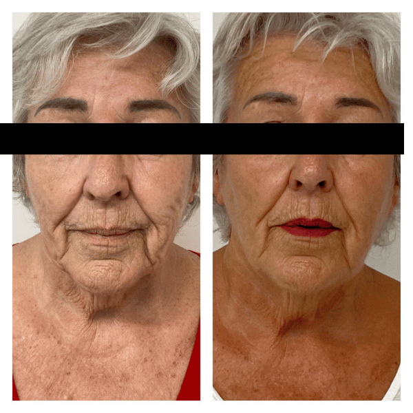radiofrequency microneedling before and after photo